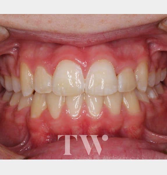 Tunbridge Wells Orthodontics - Ceramic fixed Braces