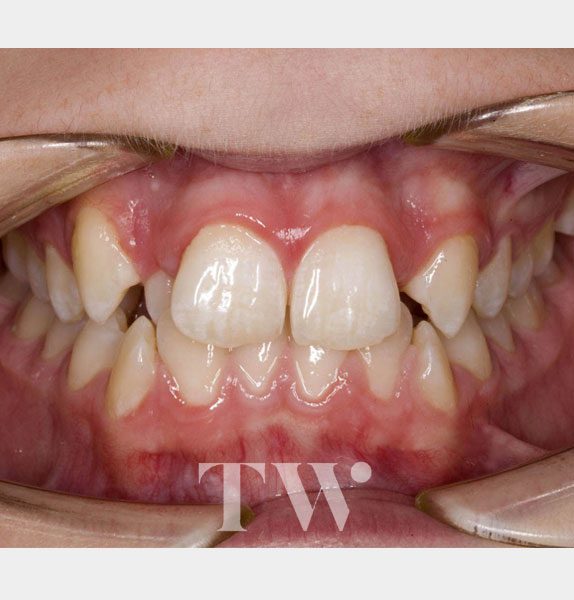 https://tunbridgewellsorthodontics.co.uk/wp-content/uploads/sites/39/2019/07/Ceramic-Braces-before-574x600.jpg