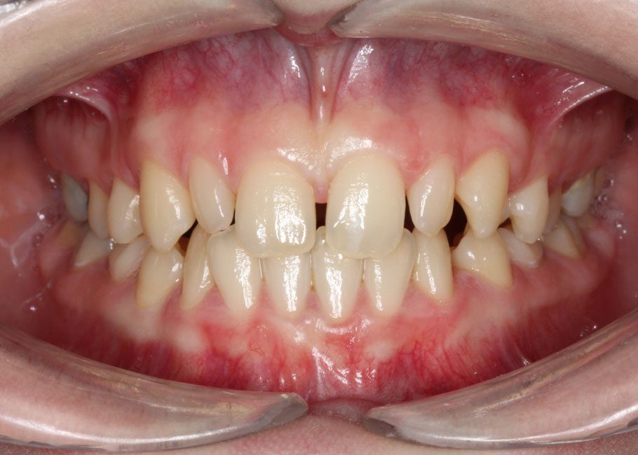 Diastema or ‘Gappy’ Teeth