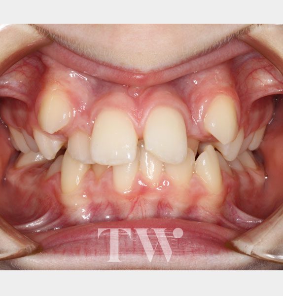 Tunbridge Wells Orthodontics - Fixed Metal Braces Before