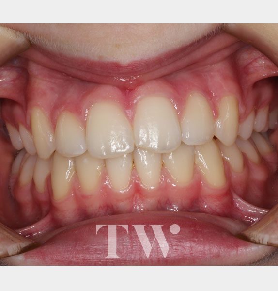 Tunbridge Wells Orthodontics - Fixed Metal Braces after