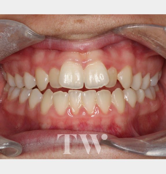 Tunbridge Wells Orthodontics - Invisalign® Clear Aligners Before