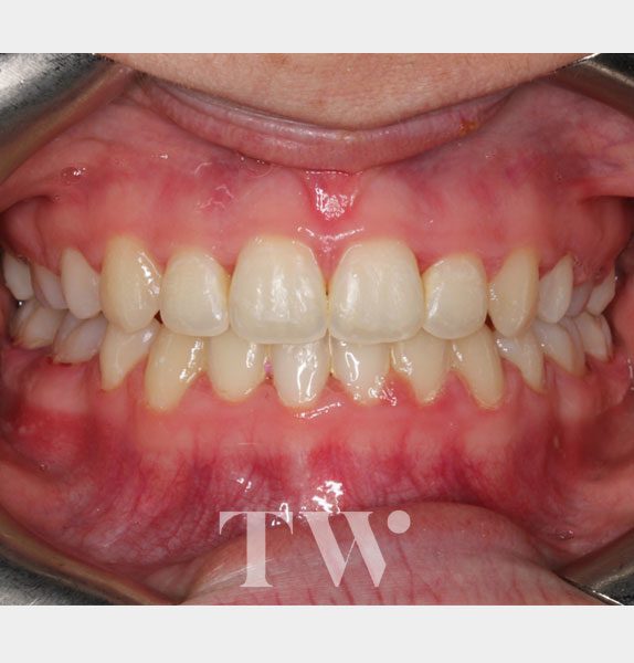 Tunbridge Wells Orthodontics - Invisalign® Clear Aligners After